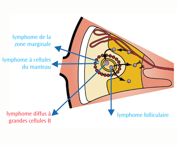 Le lymphome diffus à grandes cellules B