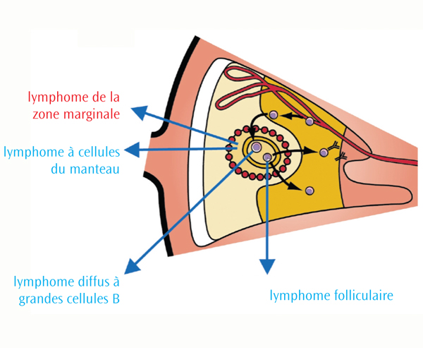 Les lymphomes de la zone marginale
