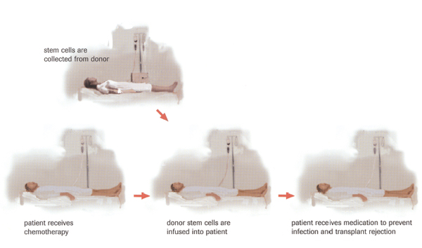 Allogeneic transplant Allogeneic transplant